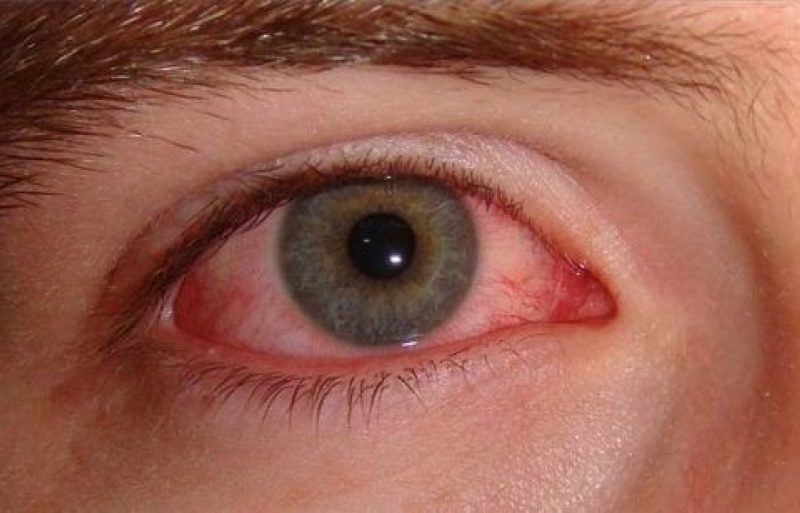 VIÊM LOÉT GIÁC MẠC DO NẤM - NGUYÊN NHÂN, TRIỆU CHỨNG VÀ ĐIỀU TRỊ